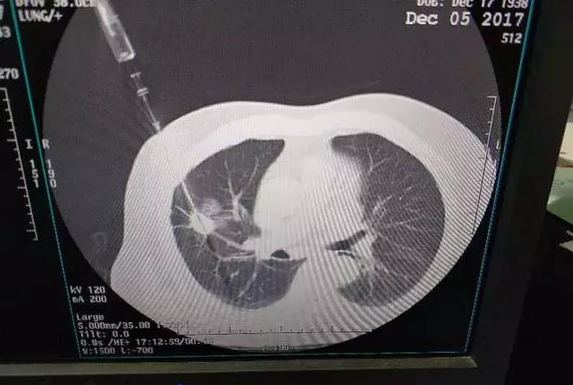 肺癌确诊只需这一步